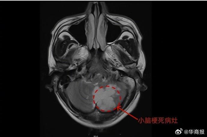 【男子脑梗询问AI后以为是眩晕症】如今，身体不适后先上网搜索、咨询AI，已成为不