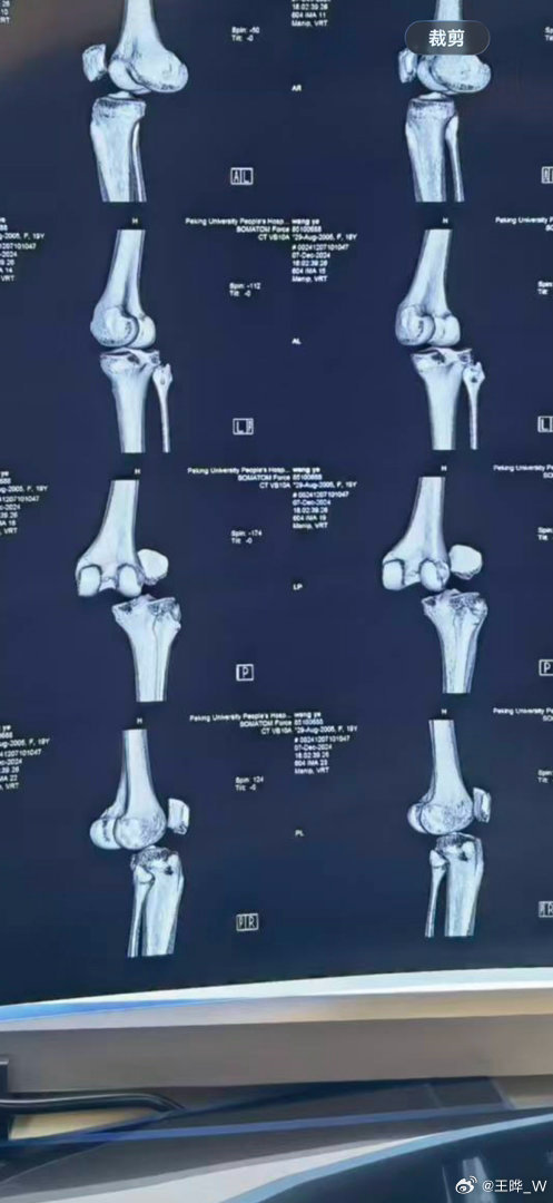 #王晔长文回顾重伤康复历程# 中国短道速滑选手更新社媒发长文，回顾自己重伤康复的