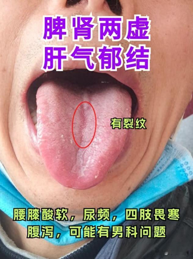 粉丝案例 :心火旺 舌苔发白
                脾肾两虚 肝气郁结