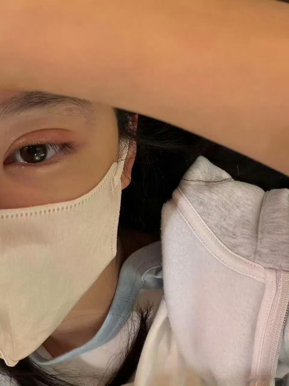 章若楠眼睛长麦粒肿了这个有办法快速消肿吗？ 