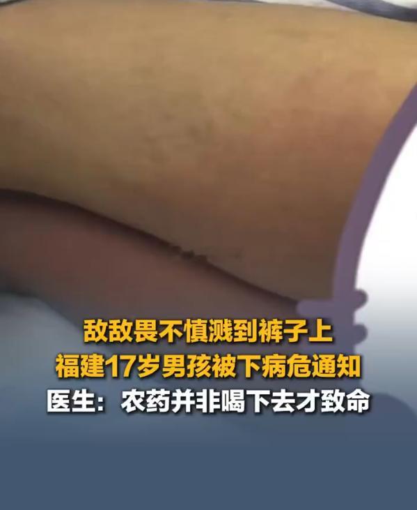 敌敌畏渗到大腿男生被下病危通知 近日，福建福州一男子在户外用敌敌畏给草丛杀虫时，