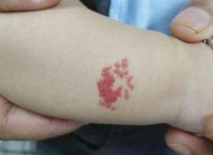 我的外甥女体检时医生发现她肝上长了一个东西，建议进一步检查。今天去医院做了ct，