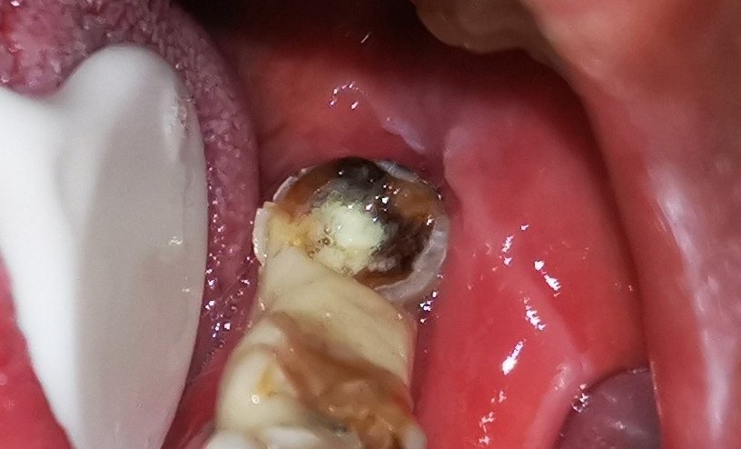 口腔科 一月多前，基层转诊一例疑似舌癌患者过来住院，舌溃疡疼痛已超四周。经检查，