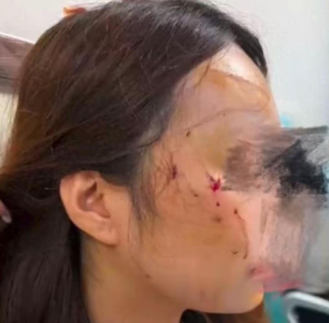 北京女子被养2年虎斑猫疯狂攻击！面颈部多处挫裂伤，现场触目惊心
5月25日，北京
