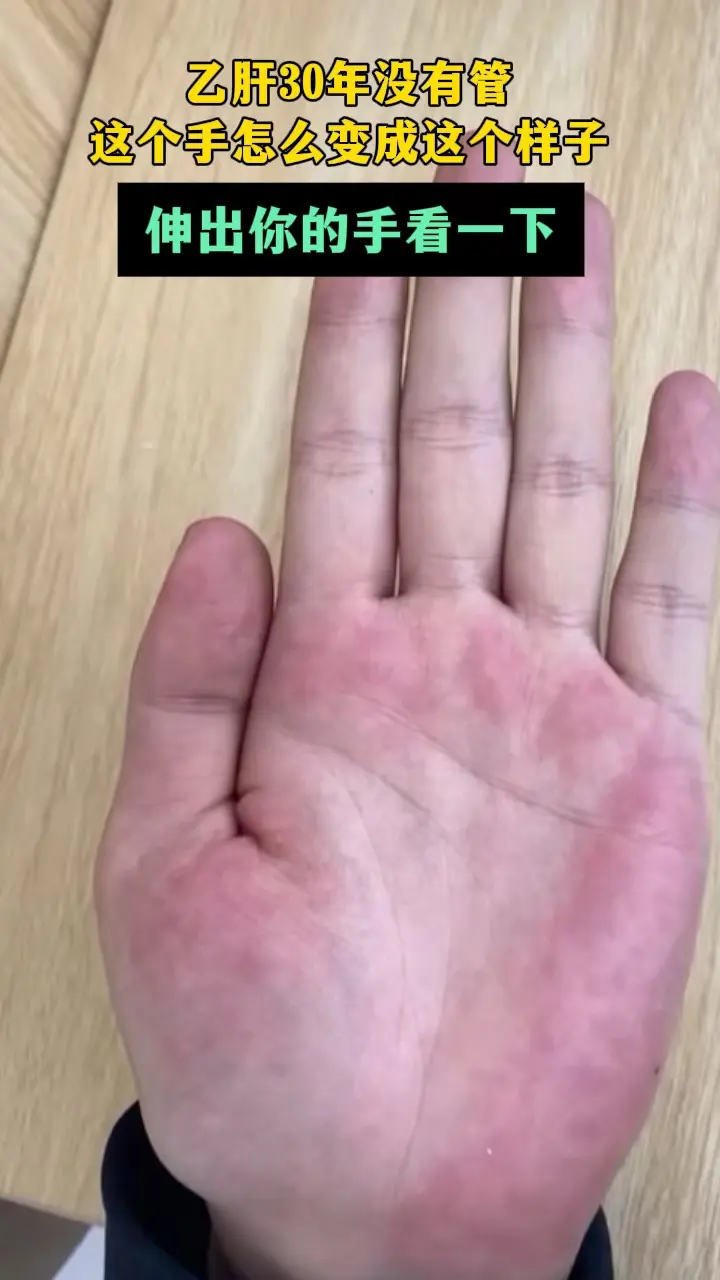 这就是肝掌。这位小伙乙肝30年没有管，手就变成这样了，肝掌大小鱼际发红...