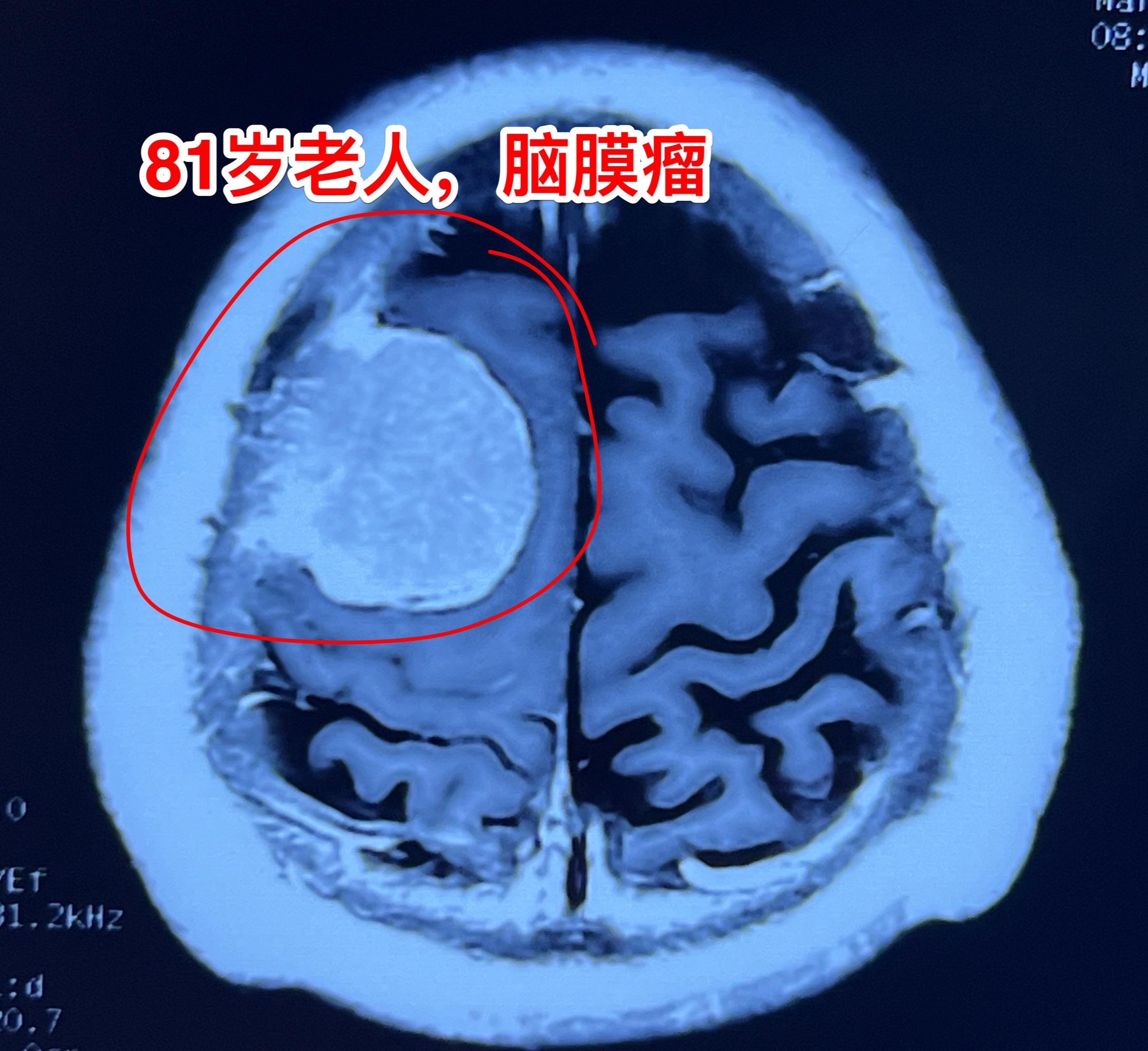 81岁老人患脑膜瘤还敢开颅手术吗？山东省枣庄市的81岁老人，今年过年后...
