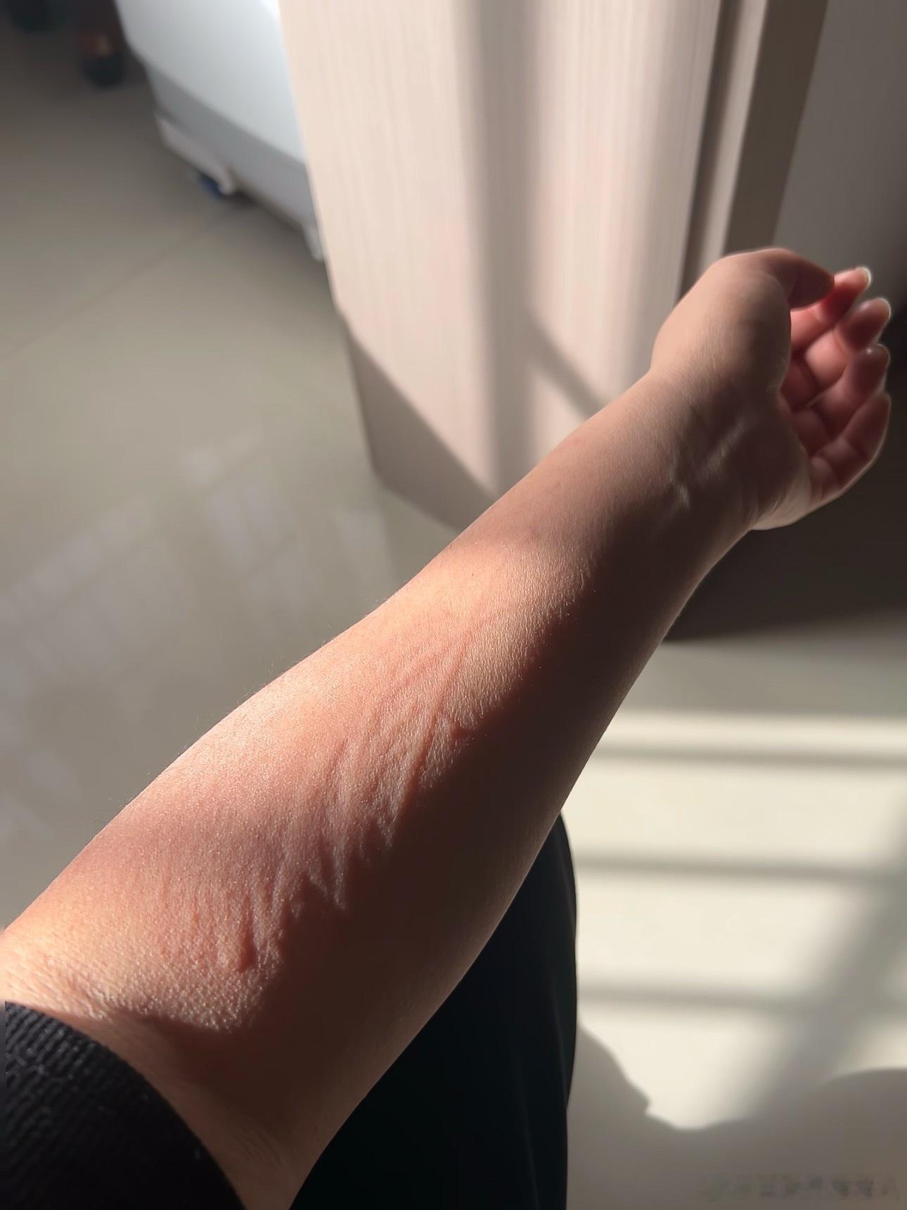 以为没事但很严重的皮肤病别单凭皮肤表面判断病情！有些看着不起眼的小疹子，实则暗藏