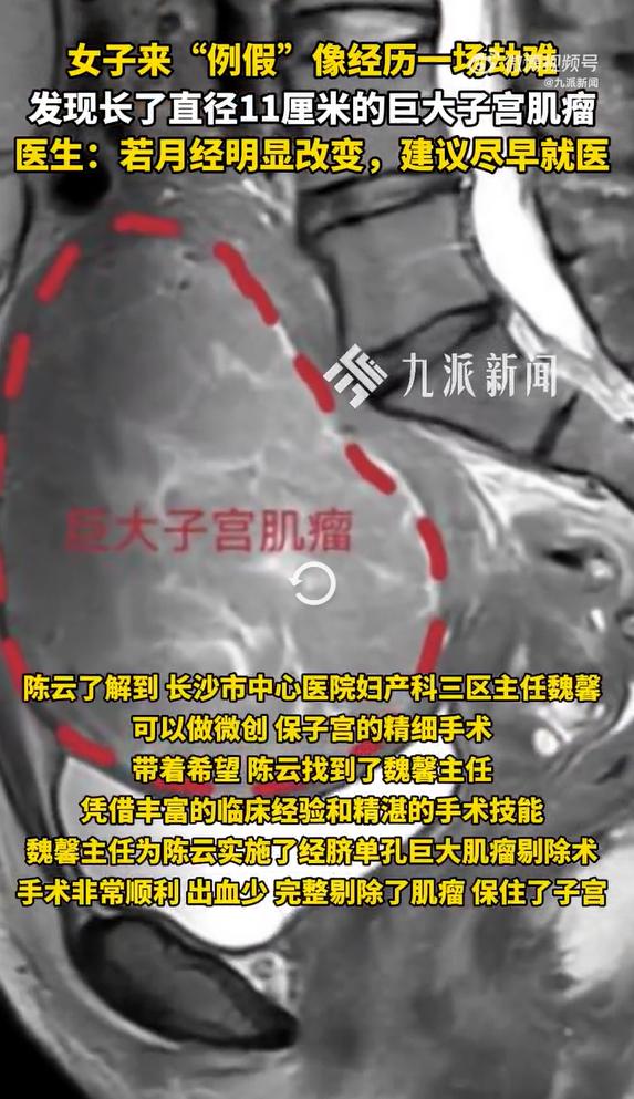 女子来例假像渡劫发现11cm肌瘤，医生提醒：若月经出现明显改变，建议尽早就医检查