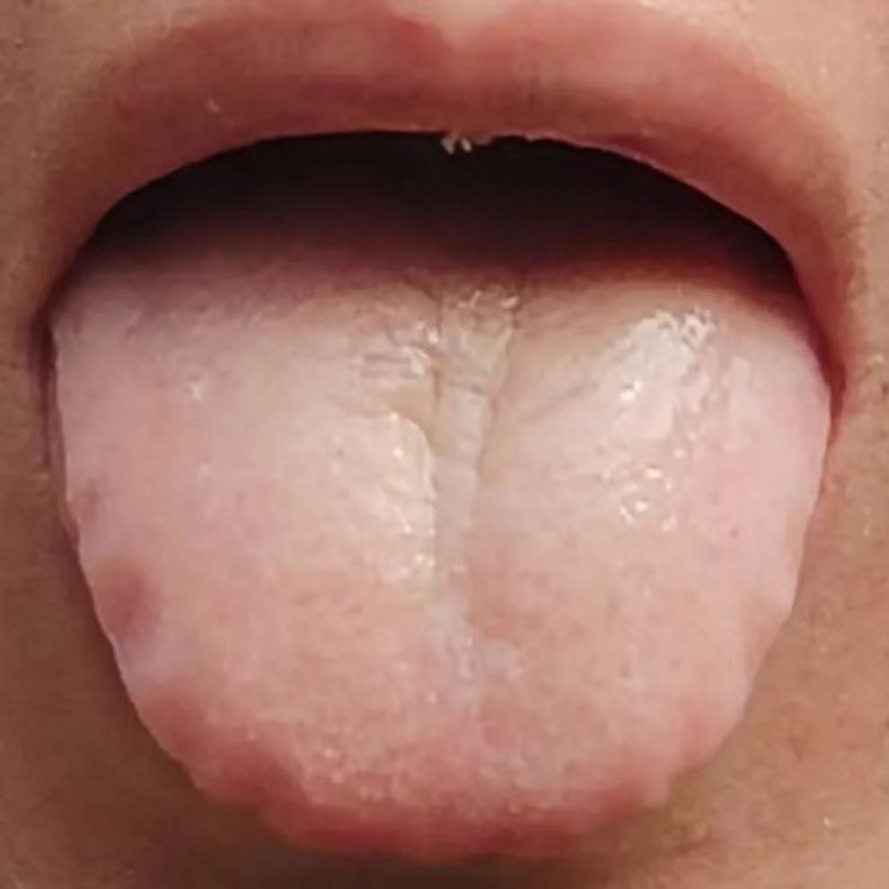 贫血只补血可不行，还要健脾和祛湿
前两天在门诊上遇见一位这样的患者，自诉贫血，脾