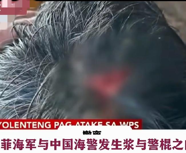 菲媒证实两名士兵受伤!
头部缝了四针，手臂手指也伤了，
冷兵器交锋，菲方败！
一