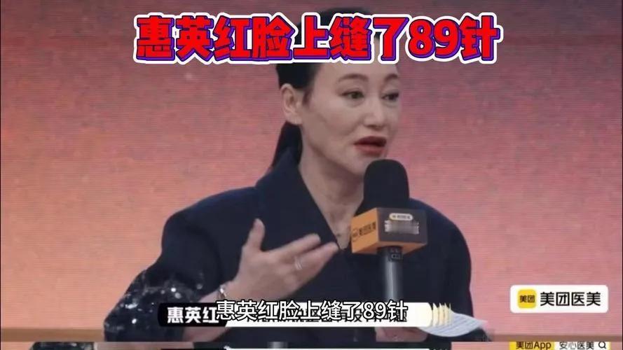 近日，于综艺节目《演员请就位3》里，惠英红自爆拍戏受伤之事，称脸上缝了89针，还