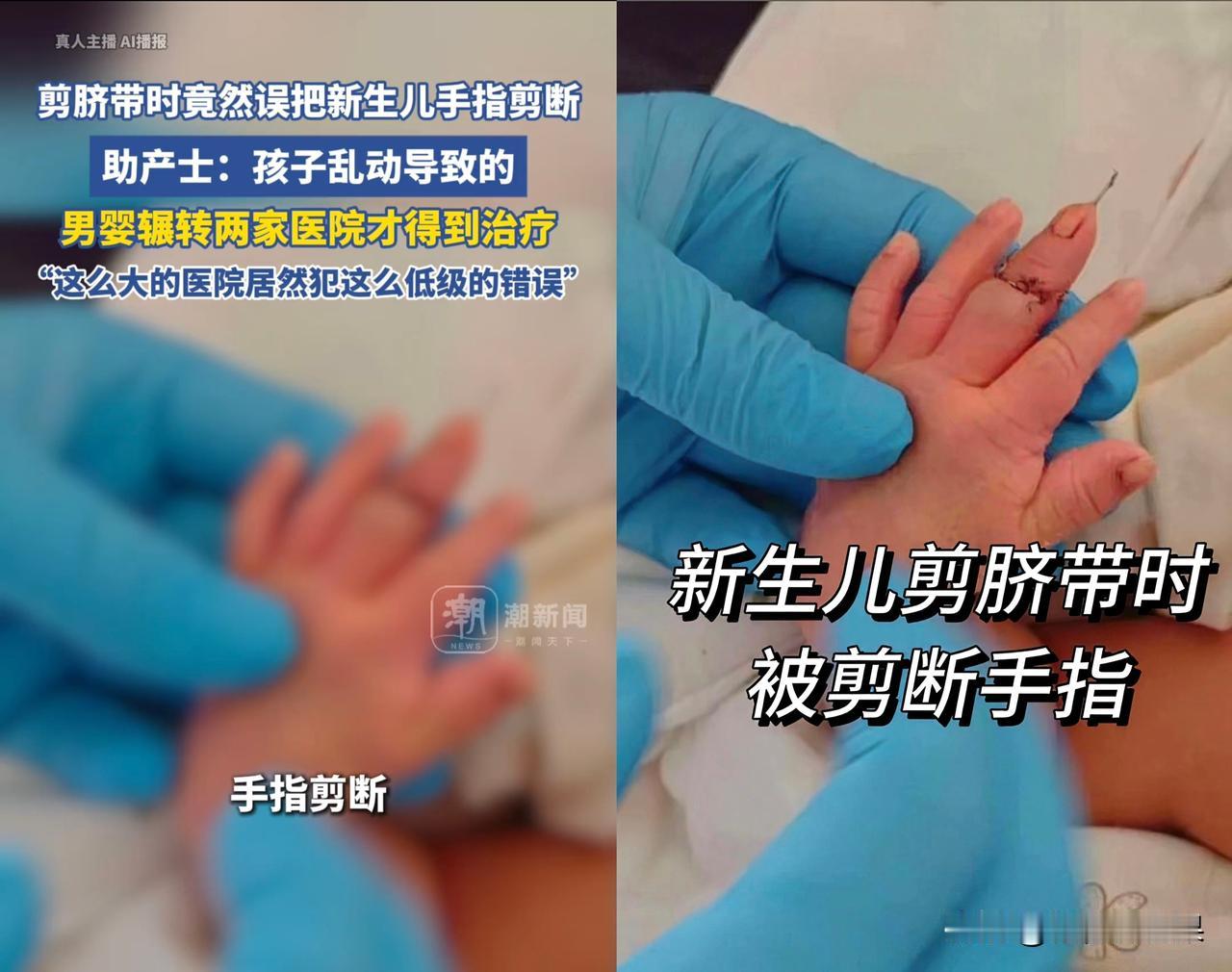 剪脐带居然能剪断新生儿的手指？
江苏盱眙的盛先生怎么也想不到，迎接儿子的第一份“