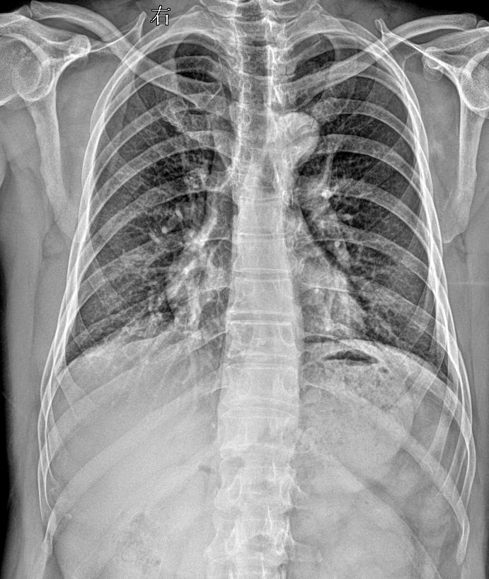 男 45外伤 胸廓正斜位