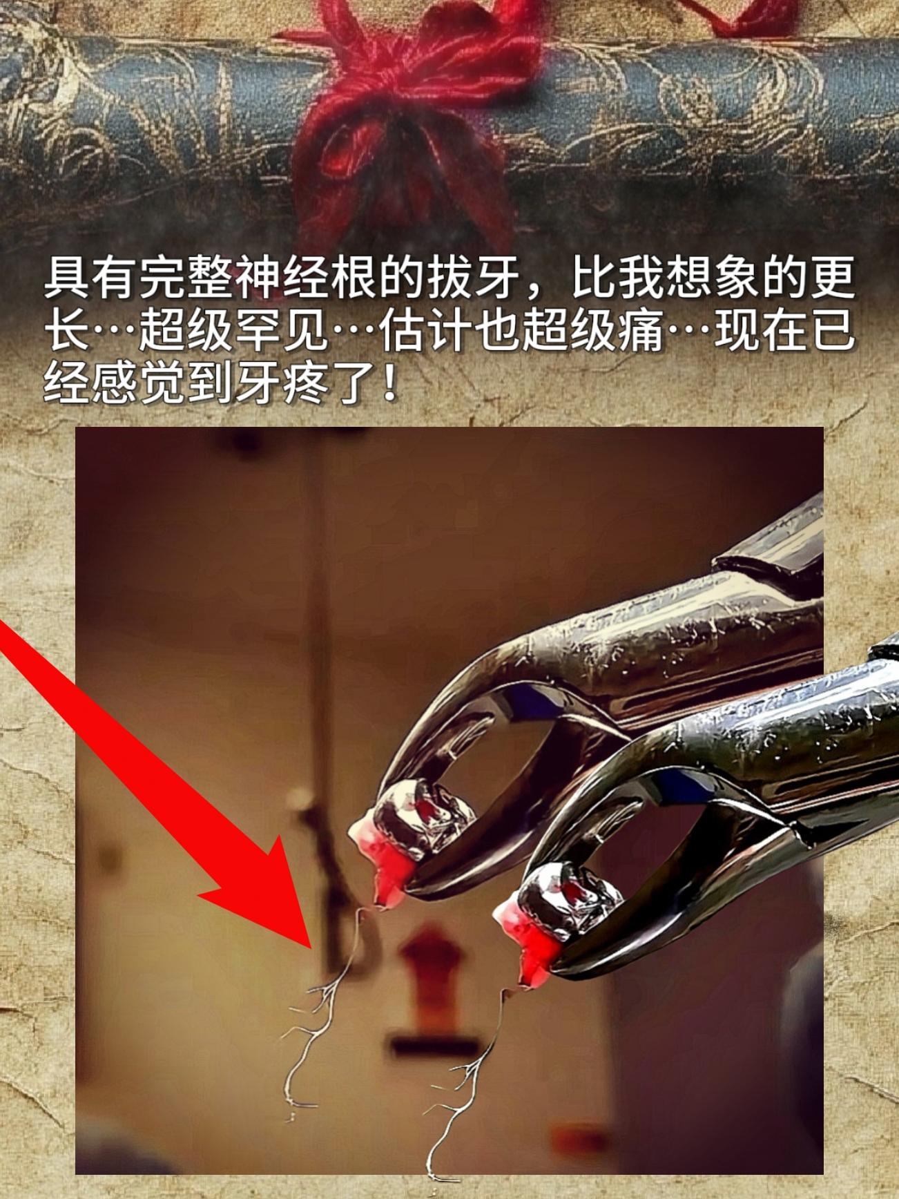 具有完整神经根的拔牙，比我想象的更长…超级罕见…估计也超级痛…现在已经...