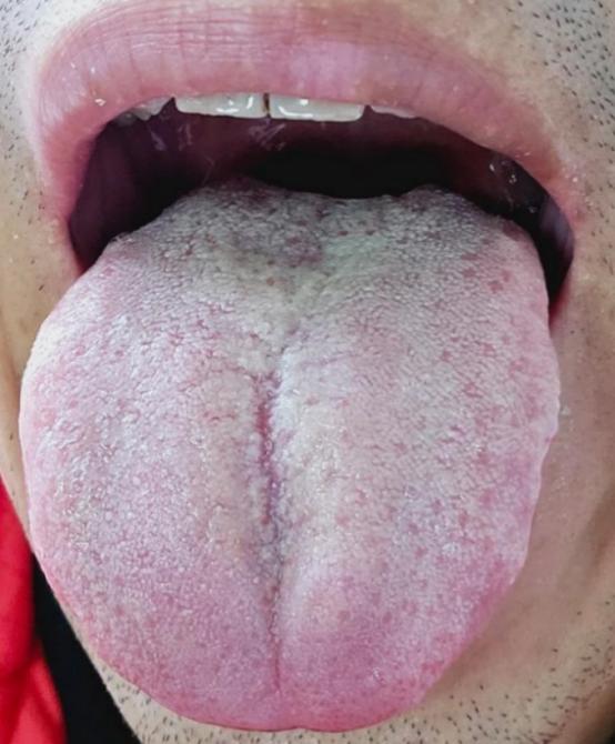 心肺不畅兼胃肠积滞的正确调理之道
在调理身体时，若不辨明体质与病症关联，盲目用药