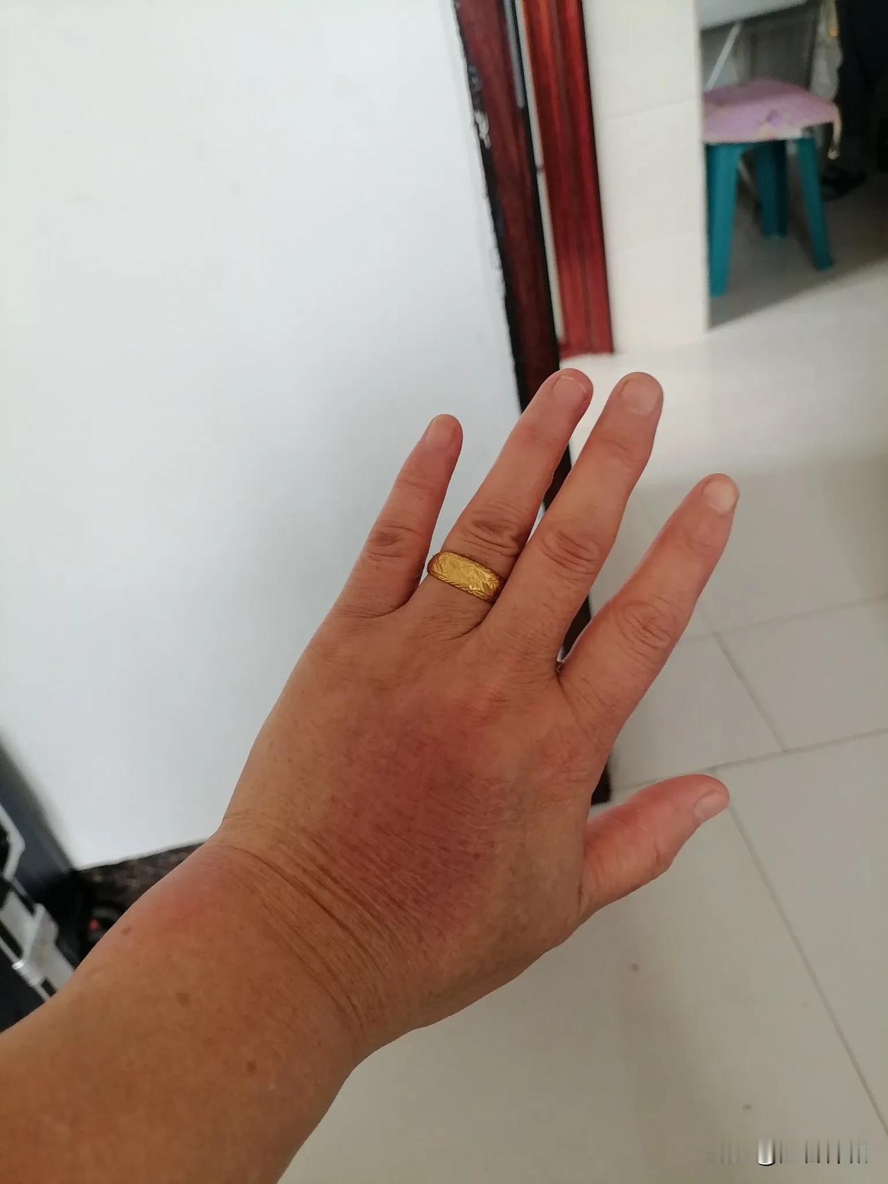 昨天下午和朋友一起去甸溪河公园散步，没有想到还被蚊子给咬了一口。

      
