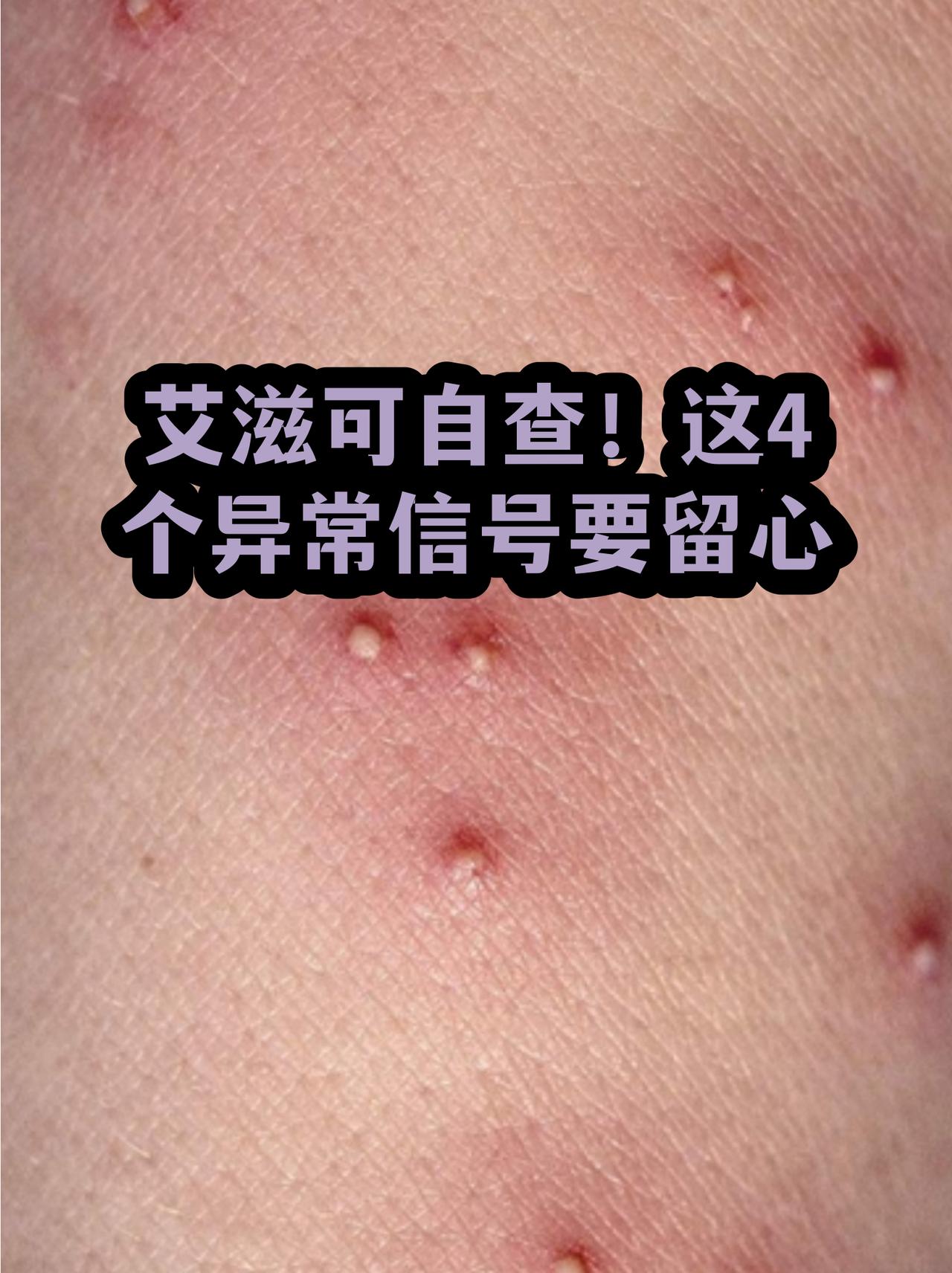 艾滋病防治刻不容缓，做好源头防控是关键。艾滋病不能完全治愈，但可预防，开展宣传教