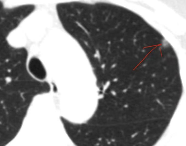 肺内7个结节，不是晚期转移！前段时间接诊了一位50岁的女患者，她拿着体检报告慌慌