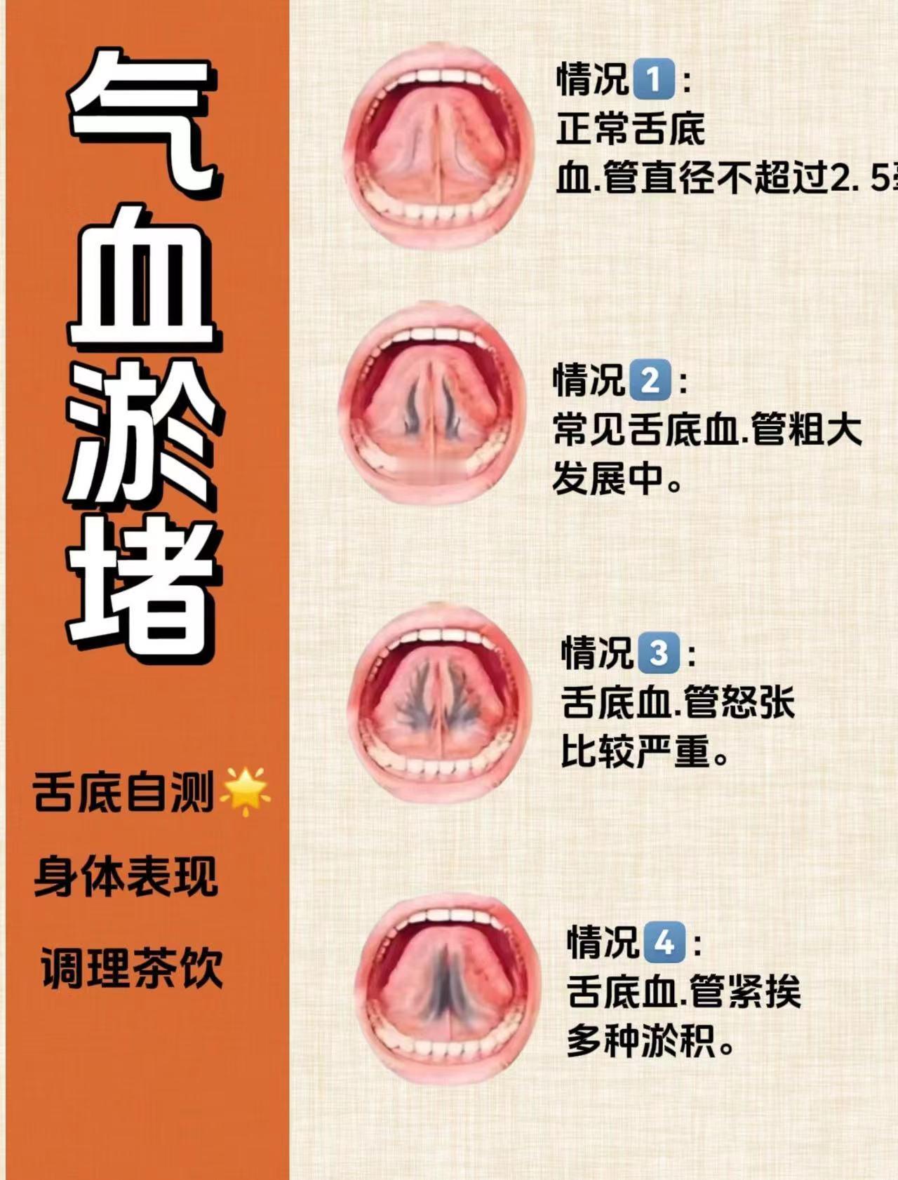 注意‼️舌下青筋又黑又粗，其实是血瘀
1⃣正常舌底血：管直径不超过2. 5毫米

