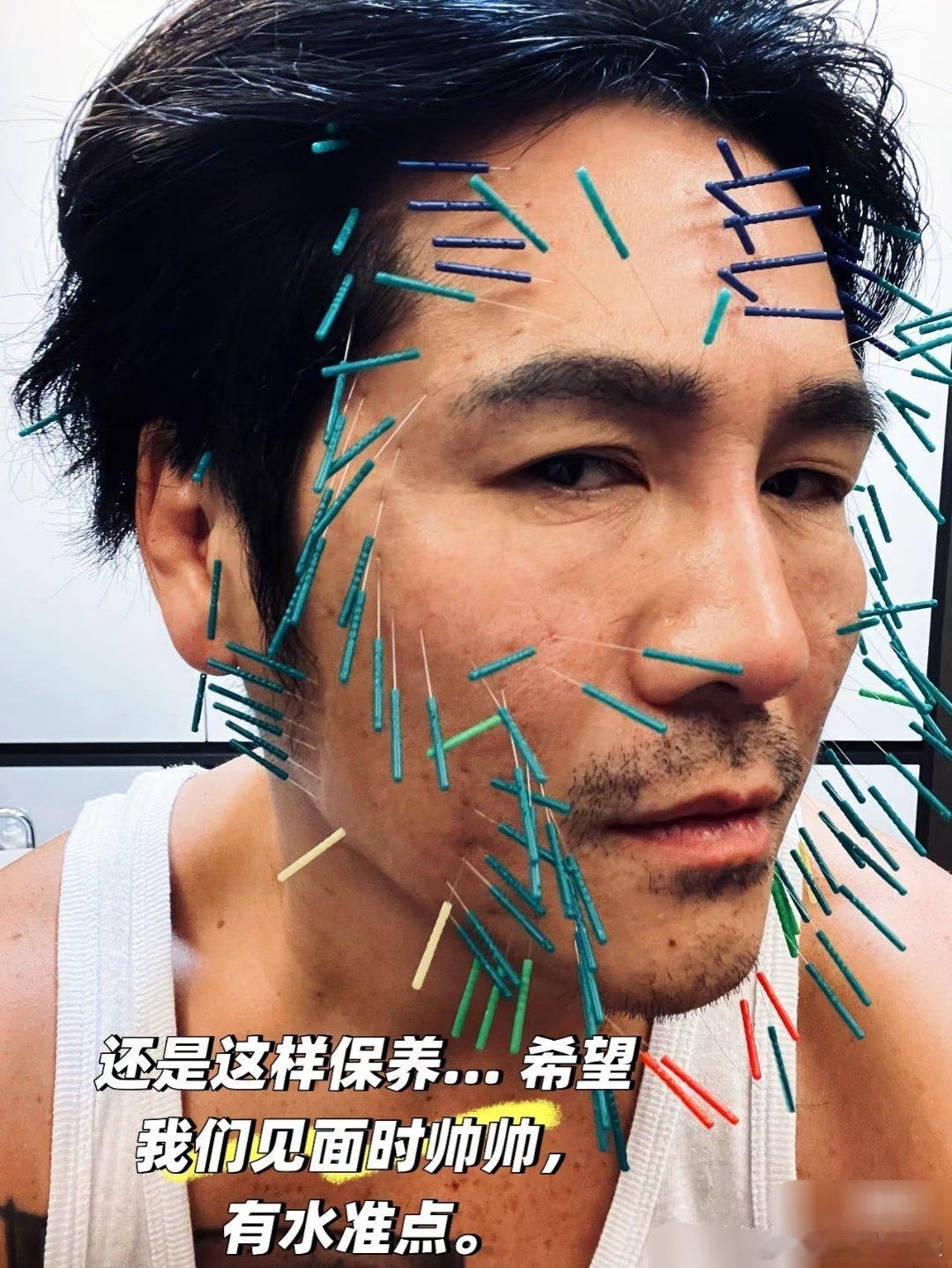 明星为啥都这么爱做全脸针灸[吃惊]曹格也做了陈乔恩同款 ​​​