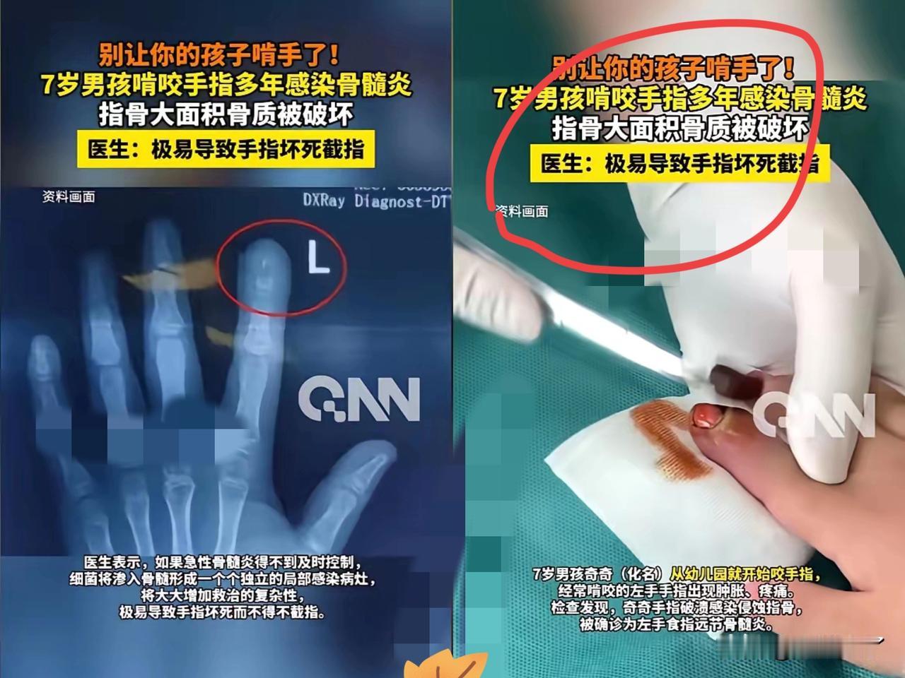 湖南，一男孩喜欢咬手指，他的妈妈尝试过各种方法都没能改掉他这个习惯，结果前段时间