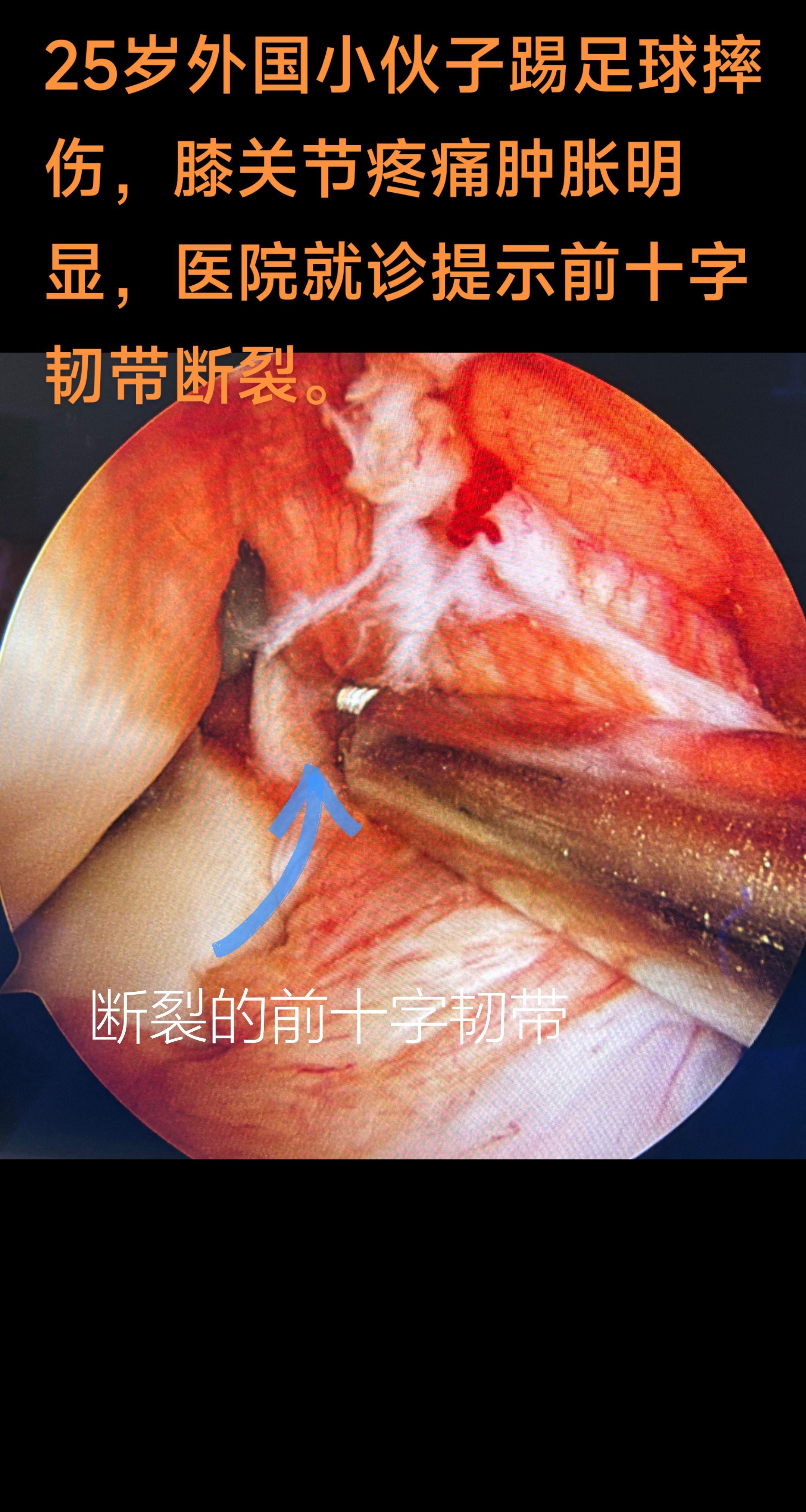 膝关节前十字韧带断裂。