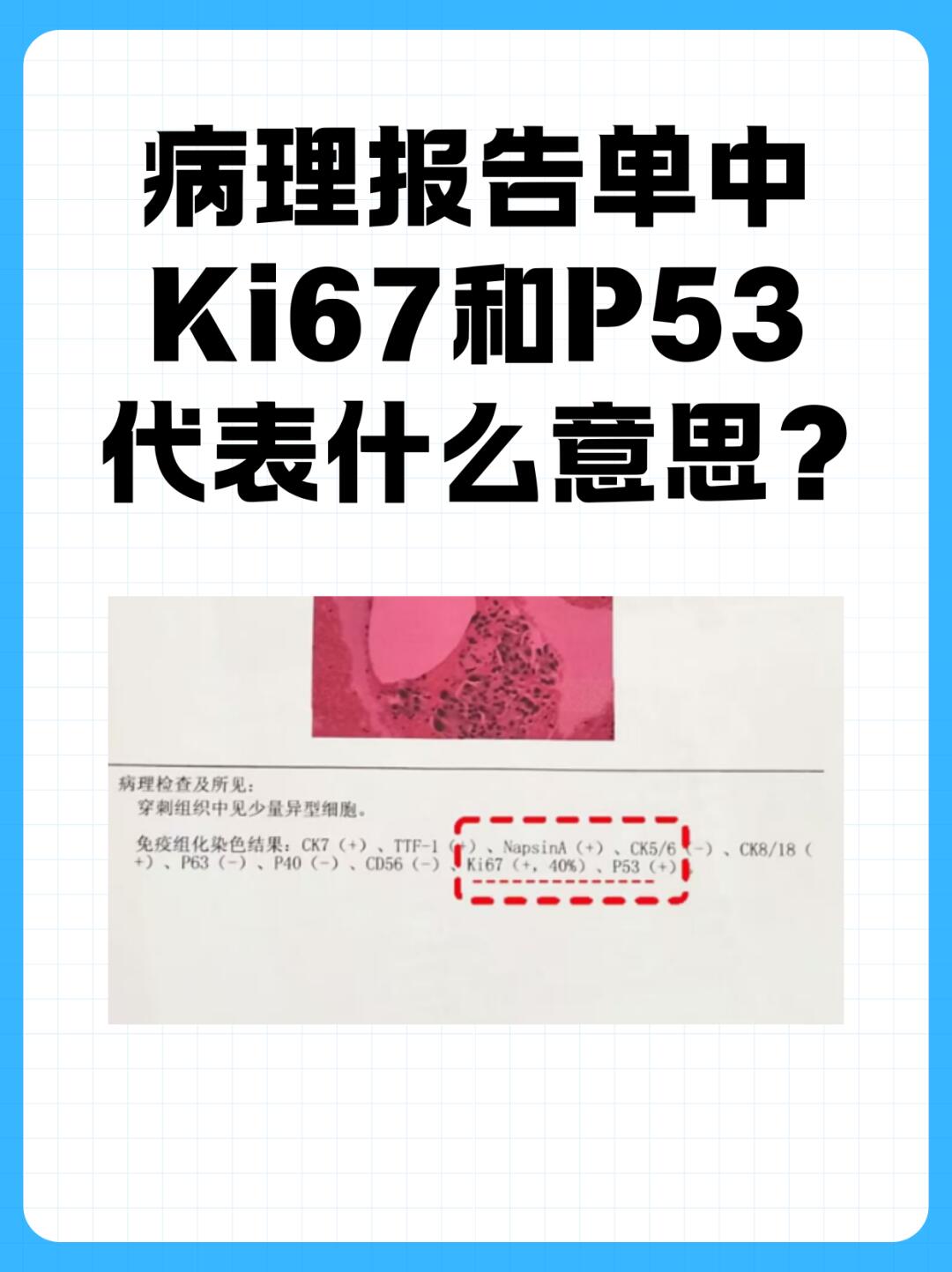 病理报告中Ki67和P53分别代表什么？