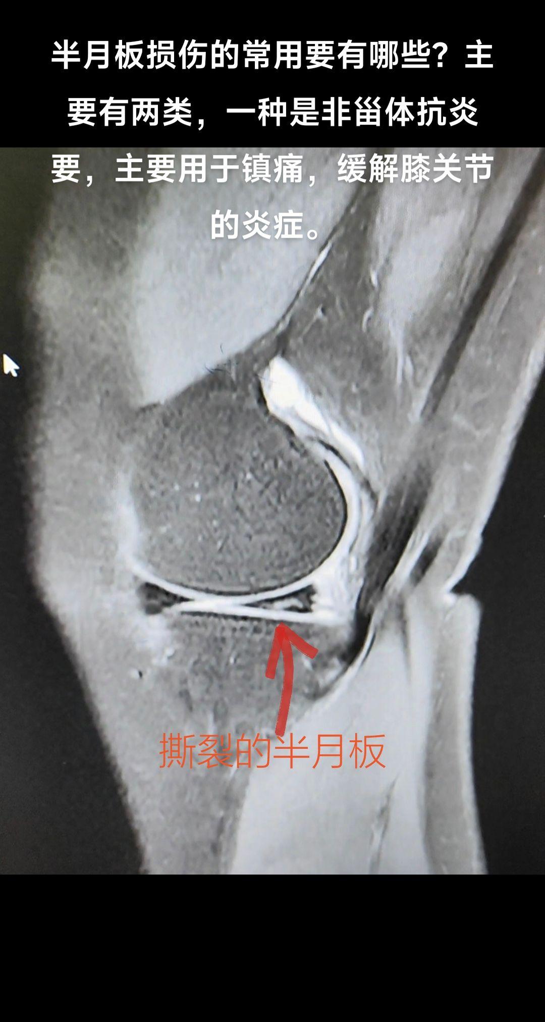 半月板损伤的常用药物有哪些？半月板损伤