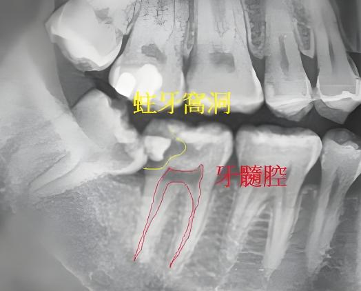 牙齿深龋需要根管治疗吗？

不一定。一般需要拍片检查+打开牙齿去腐过程才确定。