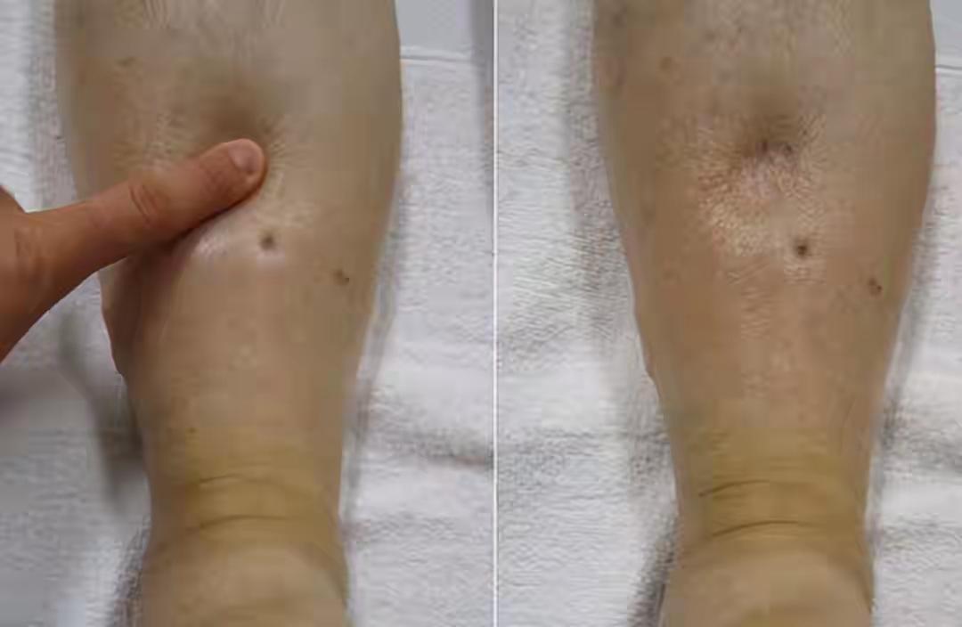 四十五岁的张先生自诩身体强健，偶尔的腰酸背痛总以为是劳累所致。直到单位体检，医生