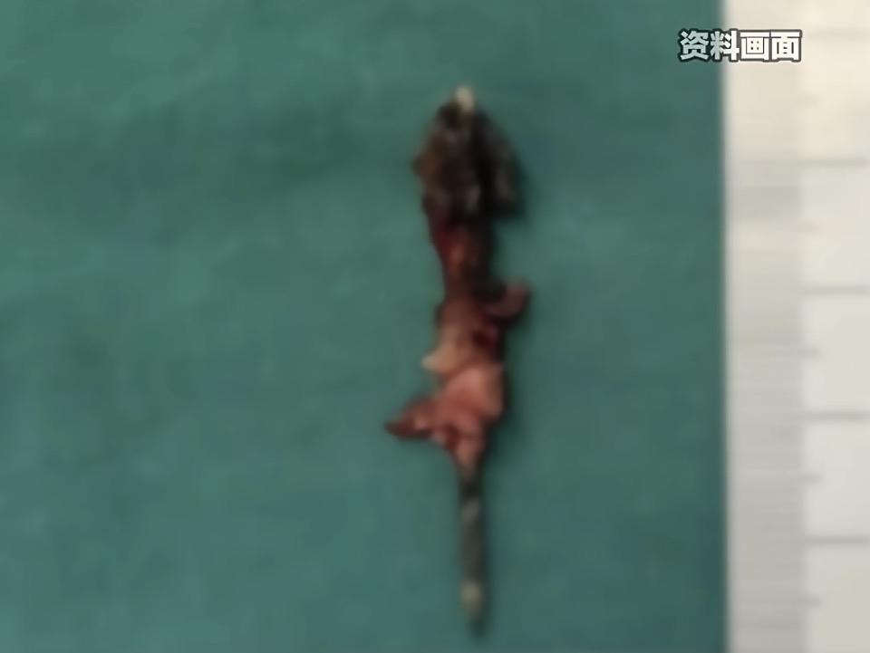 胸腔里藏了16年的“隐形炸弹”㊙️安徽17岁的少年小宇，在参军体检的X光片上，发