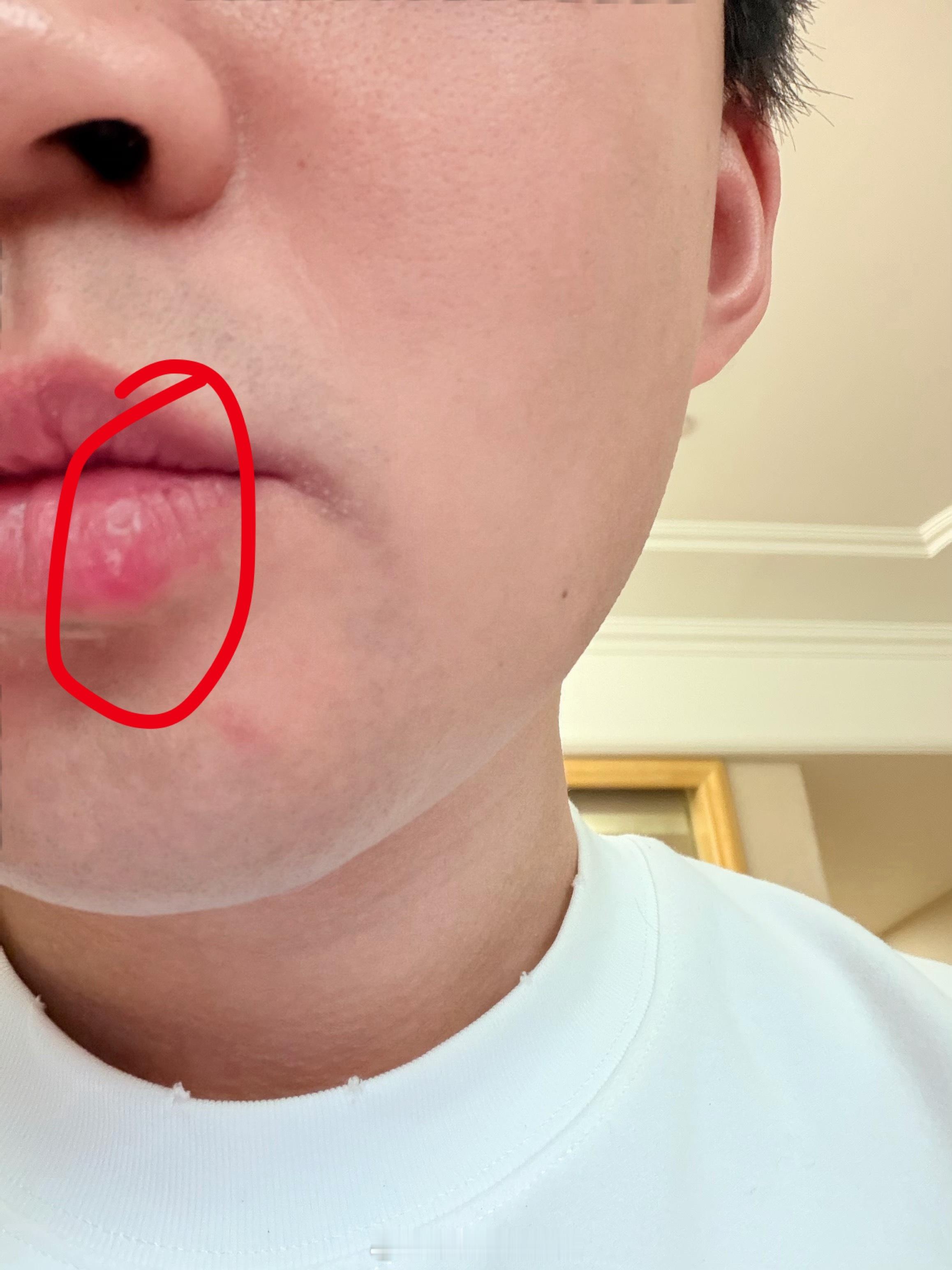 这让我怎么出门见人啊以后出门再也不吃太辣的了。上次重庆吃完，第二天嘴上起了个泡。