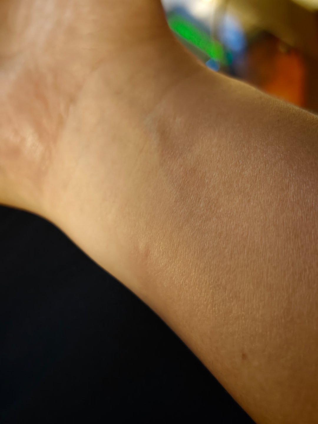 完蛋，吃了辣，过敏了，皮肤起蚊子包。