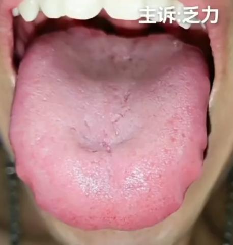 浑身乏力不想动，到底是怎么回事？中医教你逐步分析！

我们来看这位朋友的舌象，一