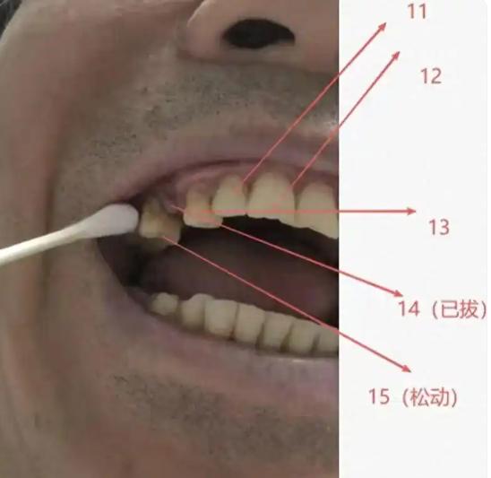 山东济南，老人因牙齿松动去医院诊治，医生因当时太忙，随手在牙片上标记了一颗牙齿，