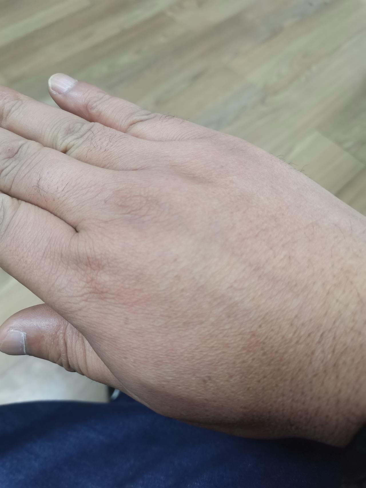 擦！我才45岁，手上竟然长起老年斑了，这可如何是好！

今天早上忽然发现，手上竟