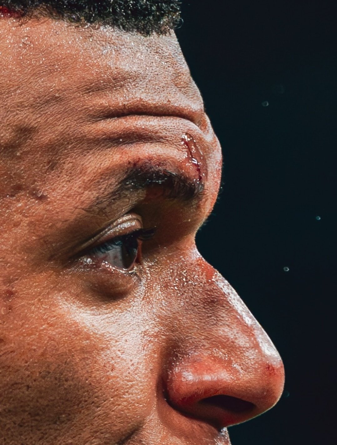 由于身体不适和谨慎起见，姆巴佩今天无法在草坪上进行训练，他右眉上方缝了几针。ha