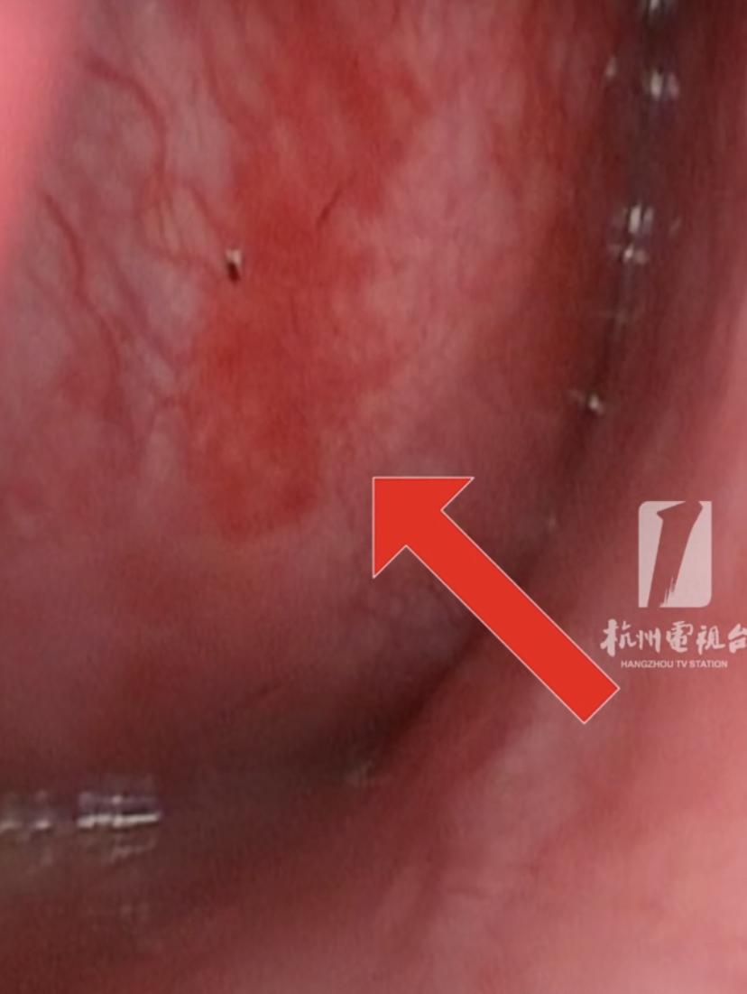 15岁男孩鼻塞3年，竟是鼻子里长了"树根"!医生：这事千万别拖
小杰从初三开始就