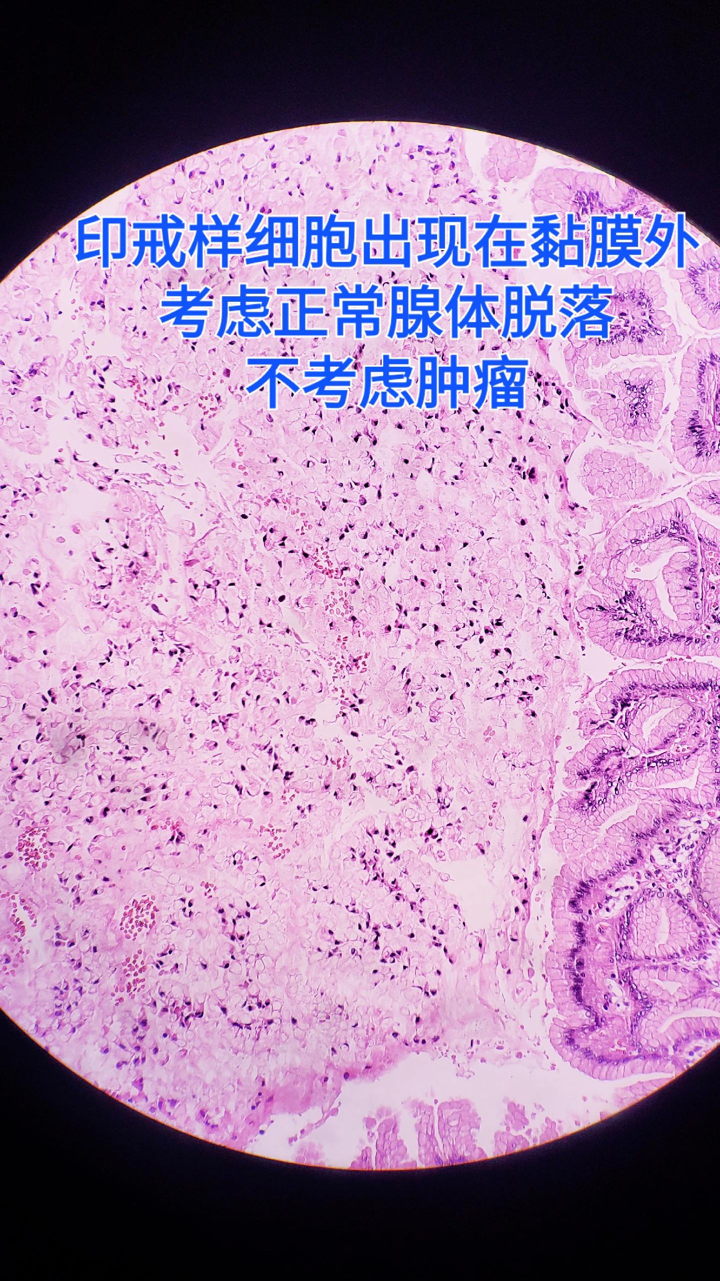 印戒细胞癌