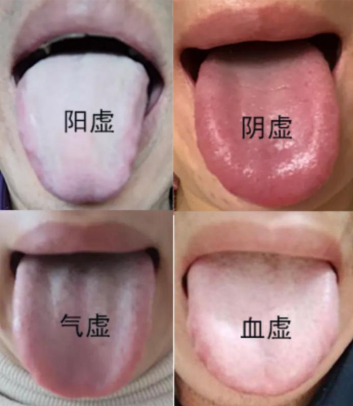人体四大虚：气虚、血虚、阴虚、阳虚，对应舌象，以及调理方法，一次送给你，建议收藏