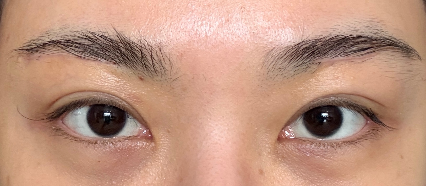 眉下切7天的反馈，这还是我天天熬夜熬到三四点，7天恢复成这样，太牛了，感觉切口基