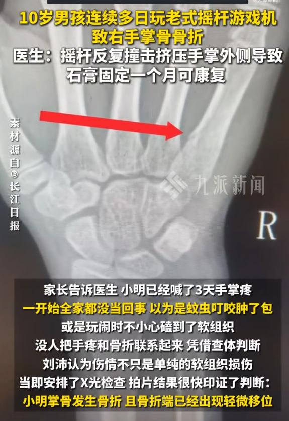 “这得使多大劲啊！”湖北武汉，10岁男孩小明连续多日在家玩《拳皇》，右手掌骨竟骨