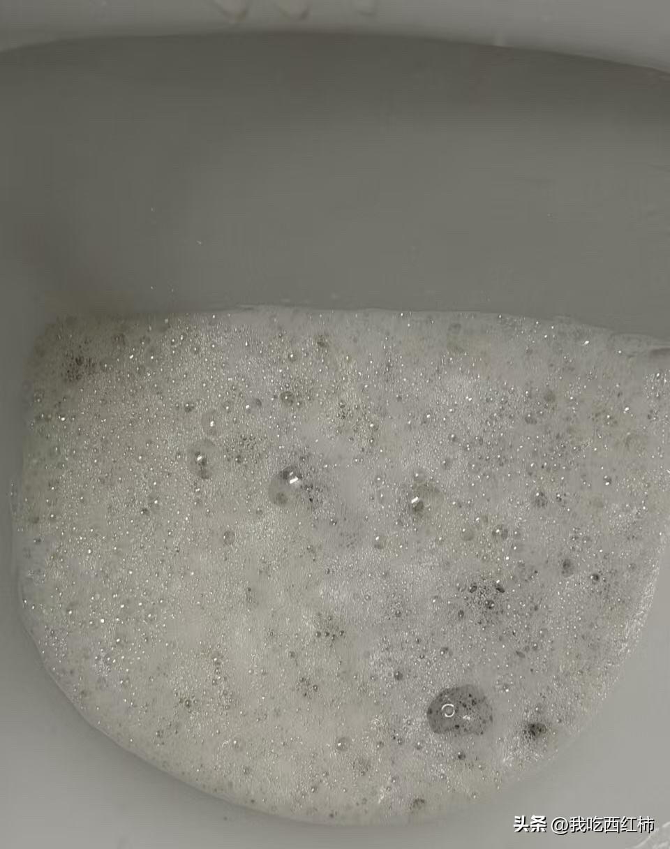 泡沫尿严重 但是检察不出来
有朋友有一样的情况么
从25年5月开始，快一年泡沫尿