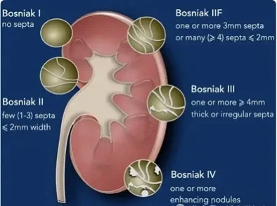 肾囊肿有严格定义，仅限特定类型🚫