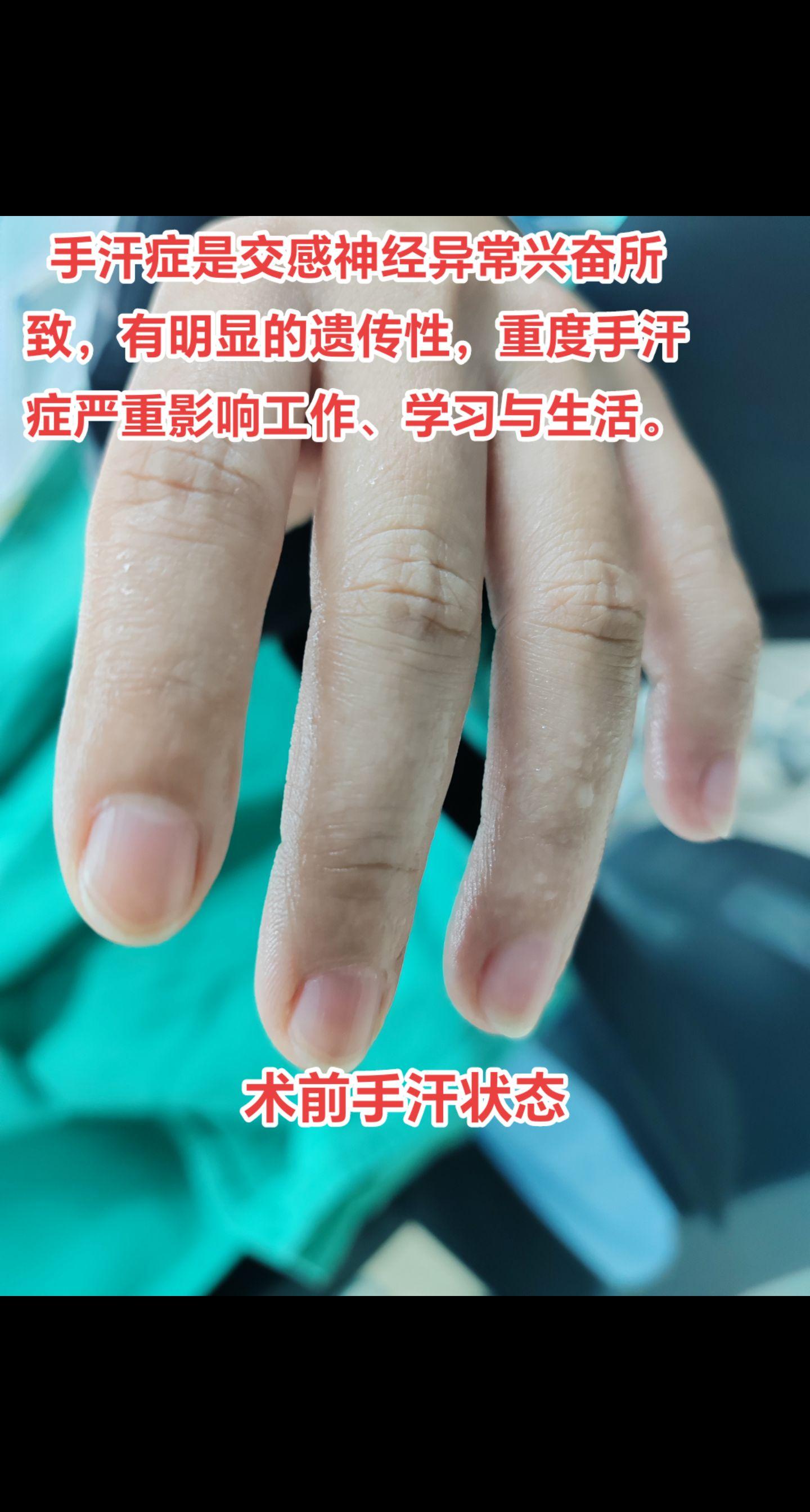 重度手汗症严重影响工作、学习与生活，一部分人合并脚汗症，手术治疗是唯一有效的方法。