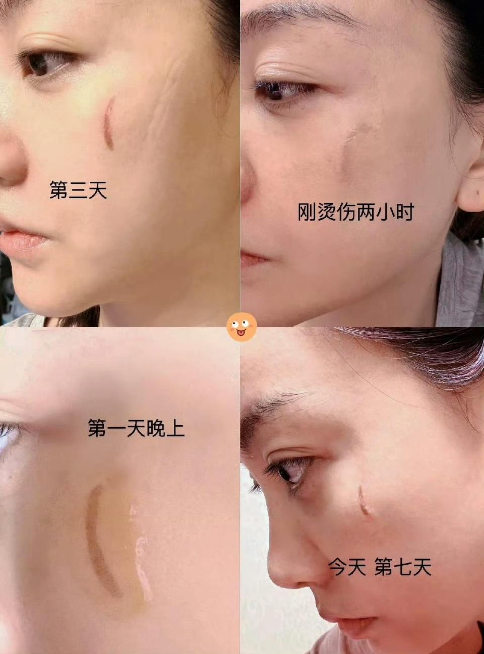 4月21日，杨蓉晒出自拍照，照片中杨蓉脸白皙光滑，一点都看不出前几天刚被烫伤过。