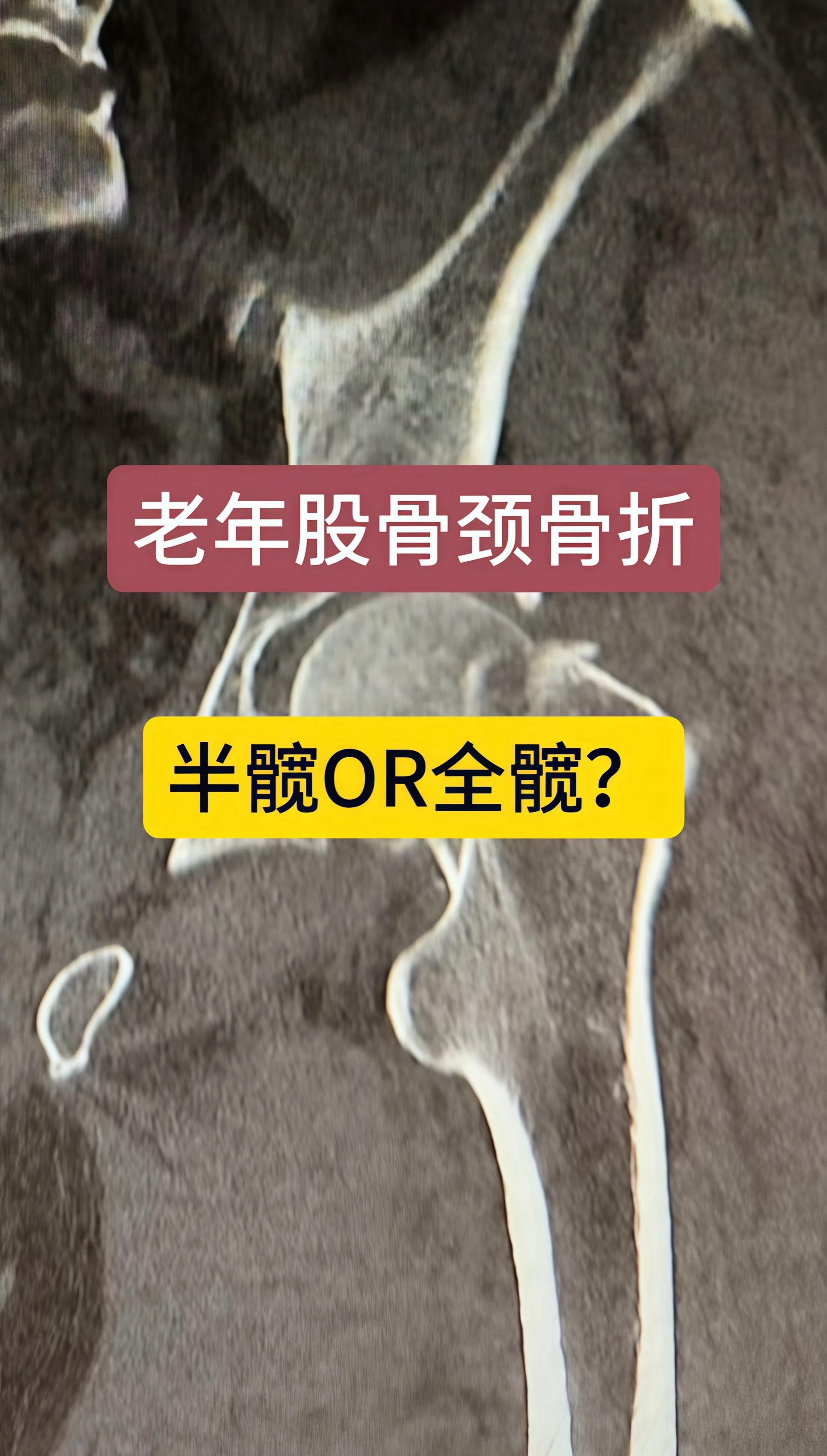 近80岁男性，摔倒后股骨颈骨折。术前活动能力强，全髋置换术后生活质量高。
