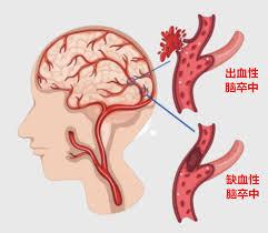 脑卒中分两种，一种是缺血性脑卒中，占85%，是因为动脉狭窄或者栓塞了，造成严重的