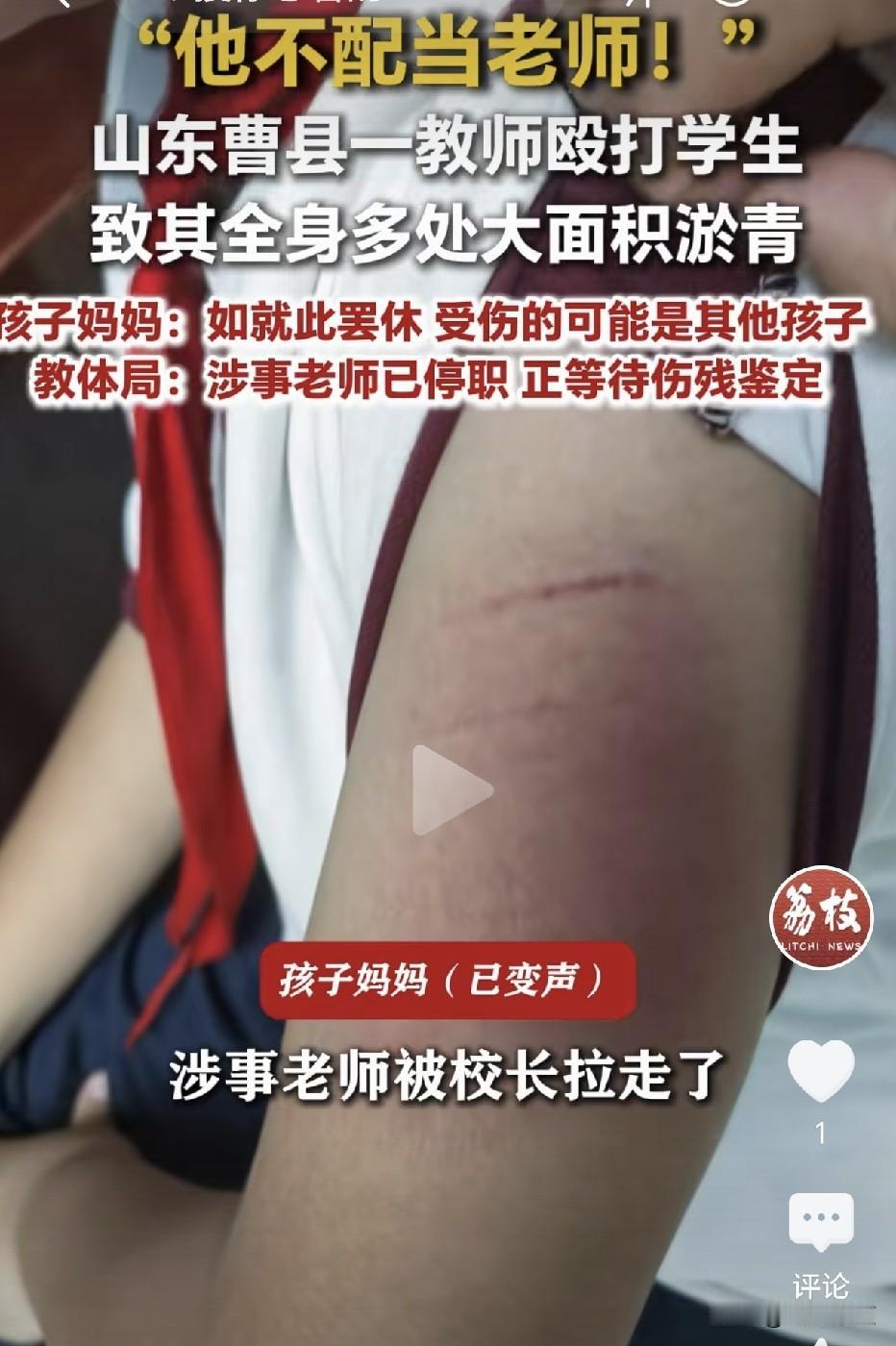 山东曹县，一名学生被教师殴打致全身多处大面积淤青，伤痕触目惊心。孩子母亲心痛发声