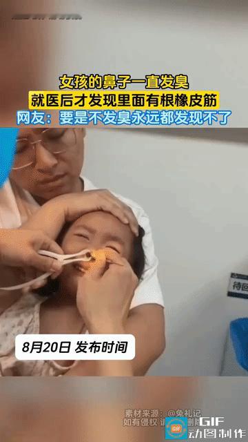 网友震惊了:女孩的鼻子一直有臭味，父母看了半天都没看到里面有什么东西，带到医院去